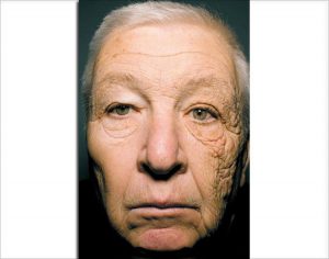 Sun damaged face